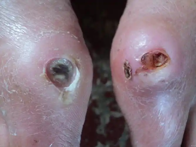 慢性皮肤溃疡就不愈合 - 中医临床经验版 - 爱爱医医学论坛