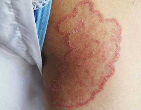 体股癣初期现象图片 (16)