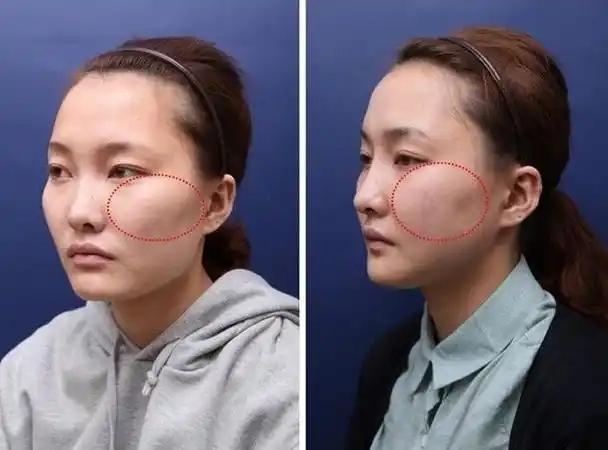 如今,人们对外貌和容貌的改善越来越重视,脂肪填充脸部作为一种常见的