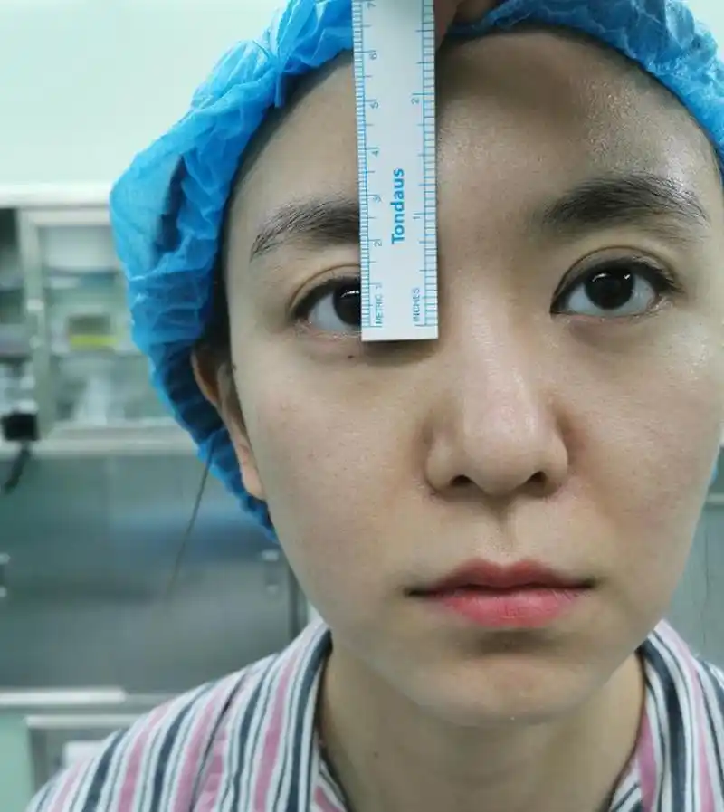 下图这位女患者下眼睑下垂,退缩,呈现三白眼,做完手术后眼神都变得