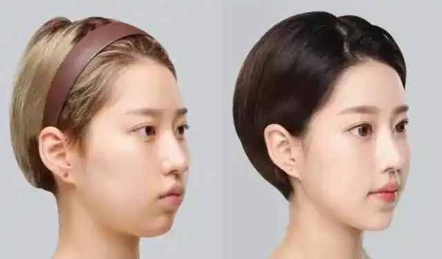 垫过的鼻子后为什么看起来不够美杭州艺星