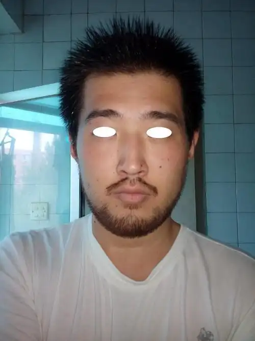 18岁,最近暑假2个月胡须长得好快,以往照镜子下巴