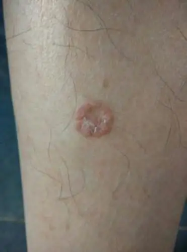 扁平疣图片初期怎么治疗