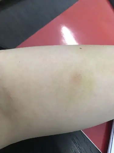 昨天身上突然长了藓一样的东西 挺痒的 不知道是什么