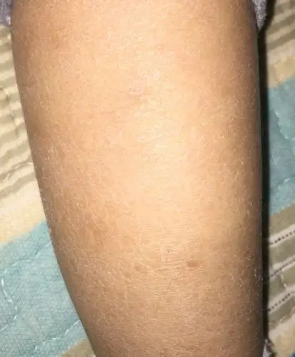 小腿两侧 皮肤病!