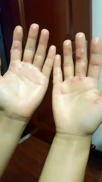 汗斑是什么症状引起的