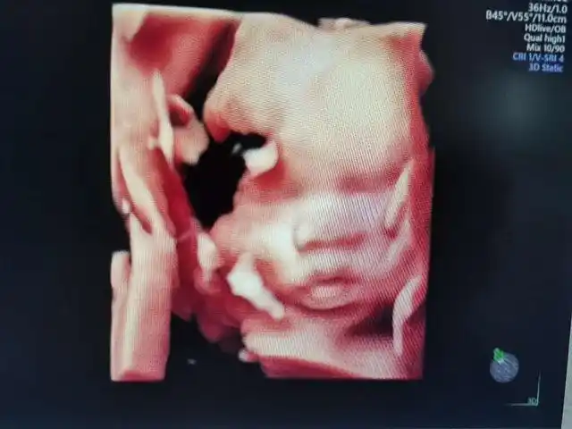 4项准备孕妈提前做好,检查才会更顺利|胎儿|排畸检查|胎儿发育|胎儿