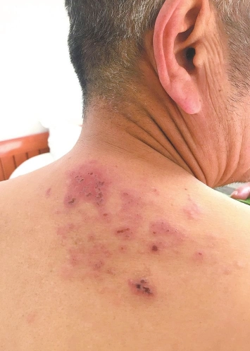 脓疱疮介绍_脓疱疮病因_脓疱疮治疗_脓疱疮医院医生_有来医生