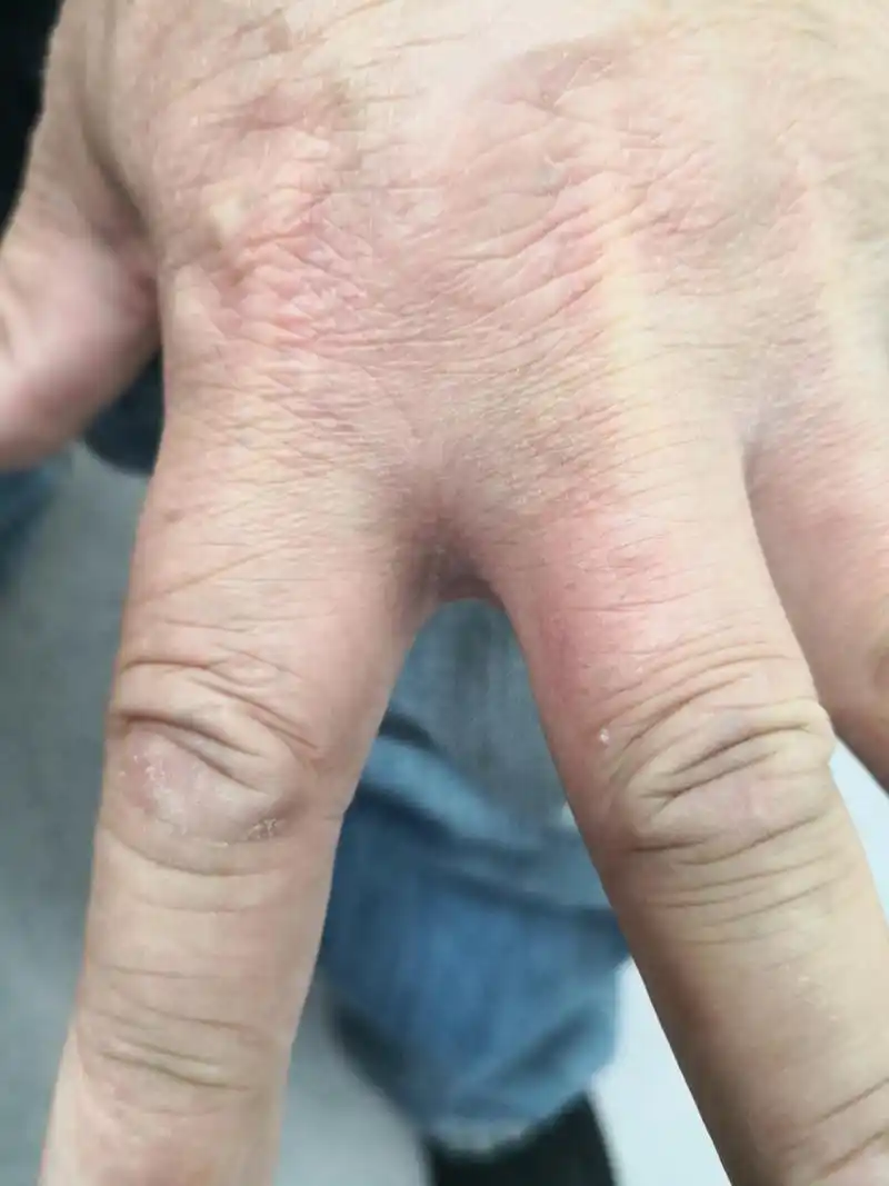 解决皮肤问题专注皮肤美容##疥疮