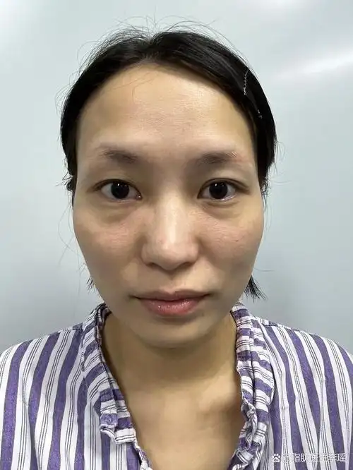 脂肪填充改善面部线条崎岖案例,这是术后7天的一个对比恢复情况