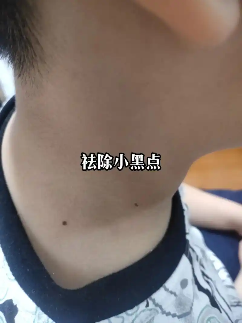 脖子上的小肉粒 ,地址陶镇大街,理发店内 - 抖音