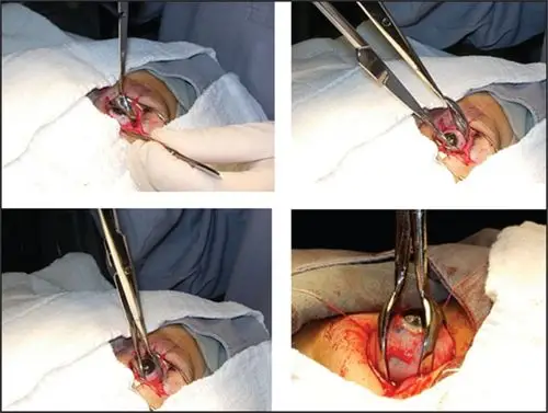 a new device for ocular globe enucleation