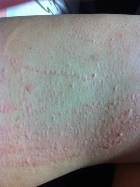 为什么皮肤痒时一挠就成这样啊?