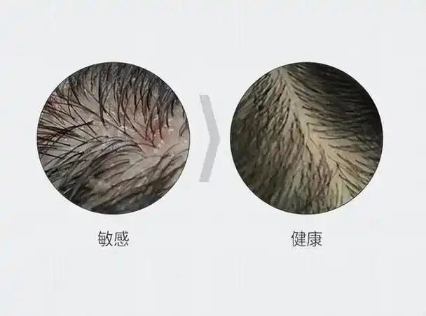 有植介:敏感性头皮是什么原因引起的?