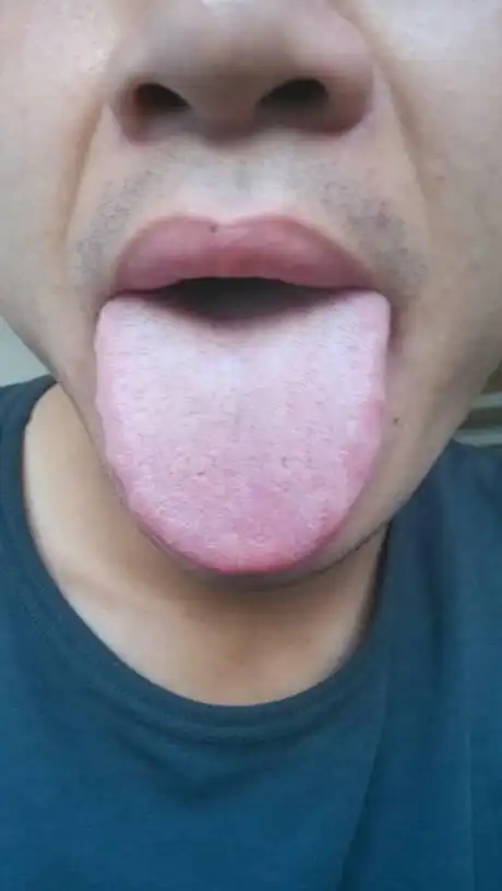 您好医生,,我恐艾能不能发些艾滋病舌苔图图片给我看看