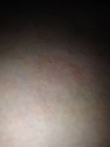 硬皮变成屑掉落泛红胸口的看样子像毛囊鼓起小疙瘩红色的聚集成的使劲