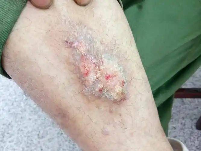 我老爸右小腿(正面)长了顽固的牛皮癣,已有十年之久,经常用药.