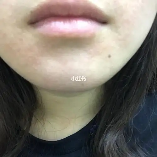 芒果过敏 怎么办 ?吃一个忍不住再吃一个 吃了三个 过敏啦