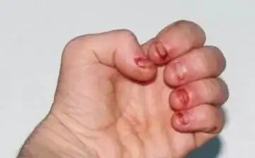 会把指甲处咬得很秃,外观上显得很难看,同时指甲失去保护手指尖的能力