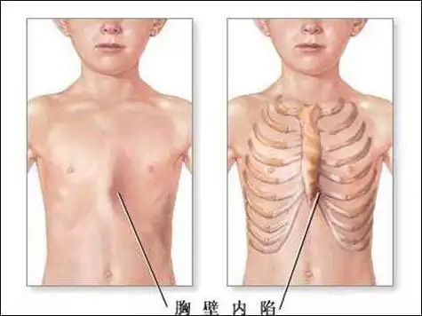 其中就包括小儿漏斗胸.