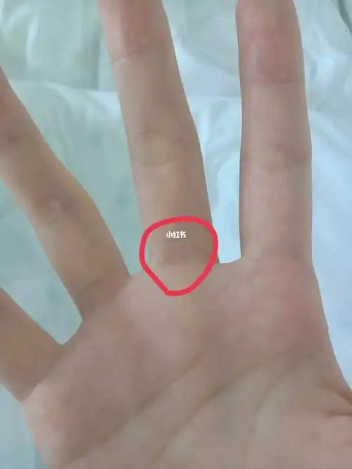 才发现右中指也有痣