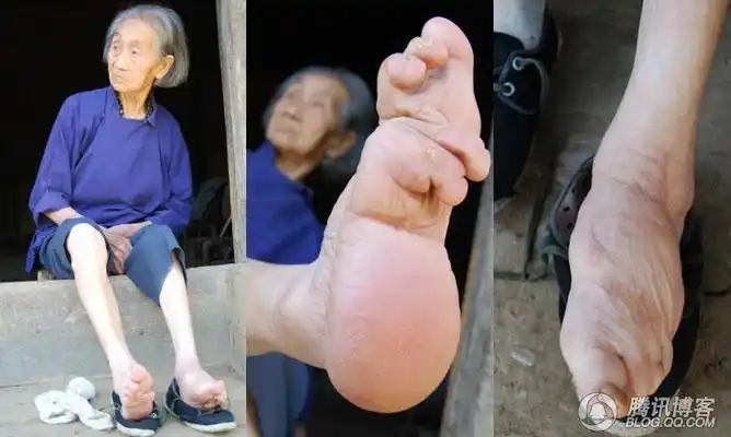 子从五,六岁开始,用一条10公分宽,三尺多长的裹脚布,把脚趾骨紧紧缠住