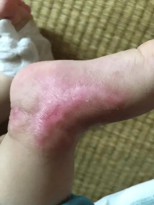 1岁小孩开水造成Ⅲ度烫伤! 我院医生采用湿润疗法治疗.