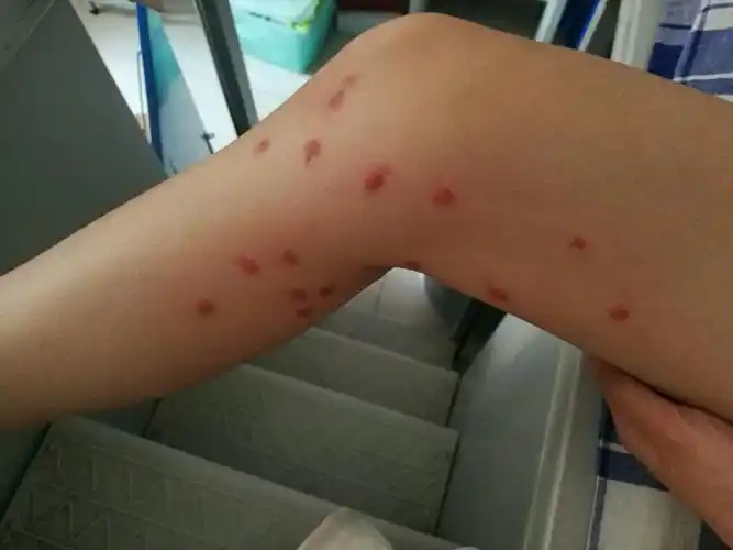 被跳蚤咬的全身都是包是什么样的感受! - 知乎