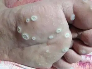 脚上长肉刺脚上长肉刺图片