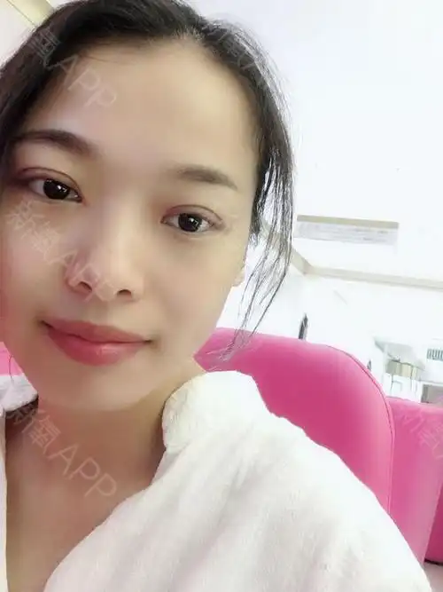 成都切开双眼皮好不好_效果图_没有名字啊切开双眼皮术后第20天_新氧