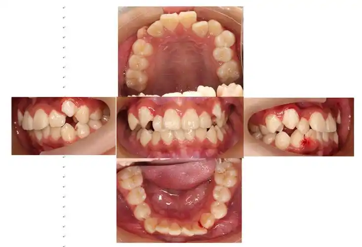 牙列拥挤病例拔除四颗双尖牙 - 好大夫在线