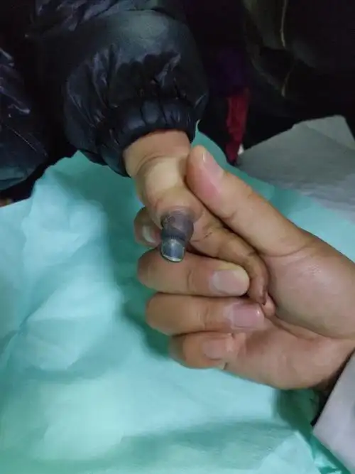 拇指坏死,只因不懂手指包扎法