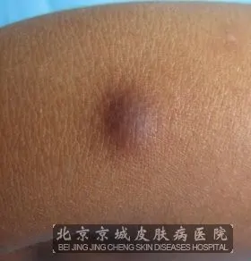 皮肤纤维瘤的发病原因