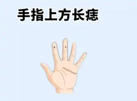 手指上有痣代表什么 (是吉还是凶)