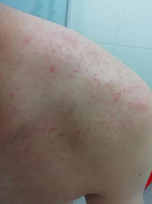 后背长了很多红点,非常痒 - 皮肤及性传播疾病讨论版 - 爱爱医医学论