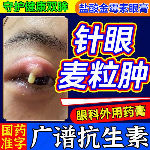 盐酸金霉素眼膏贴 麦粒肿眼膏治麦粒肿针眼撅眼消炎药 治眼部细菌感染