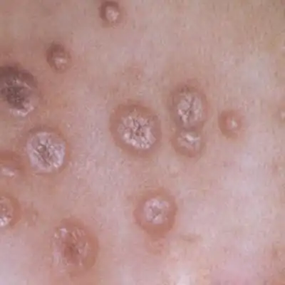 硬下疳初期图片8