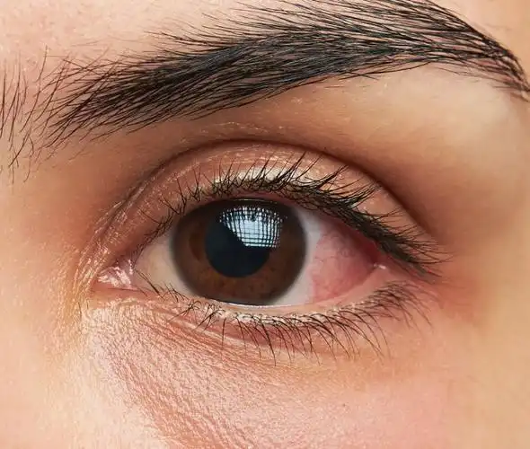 原创眼睛有红血丝好好休息就行了不是出现这几个症状需就医