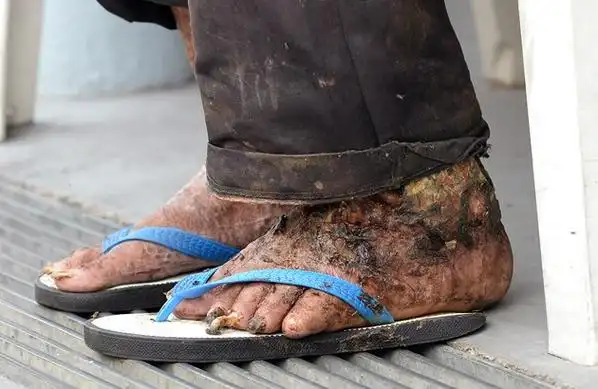 独居老汉左脚爬满蛆虫发出恶臭,却担心截肢拒绝接受治疗,家人,邻居和