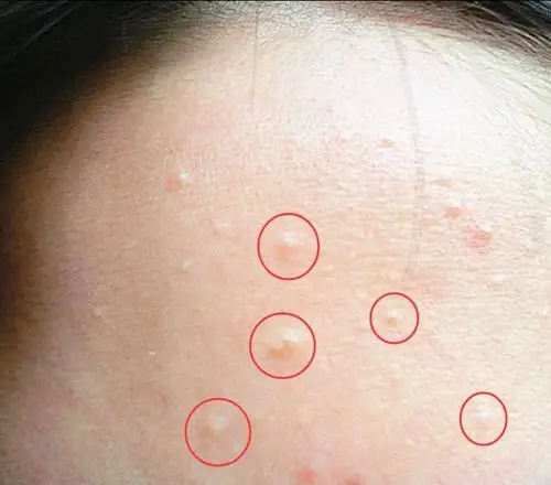 刘诗诗高级磨皮都解决不了的满脸闭口痘谁帮我告诉她刷个酸就行