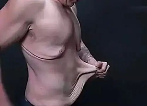 面部吸脂会不会导致皮肤松弛面吸后遗症有哪些