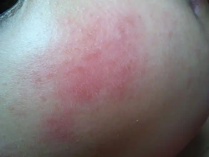 脸经常过敏,不是食物问题,右边颧骨周围一直红着,有时候很淡看不出有