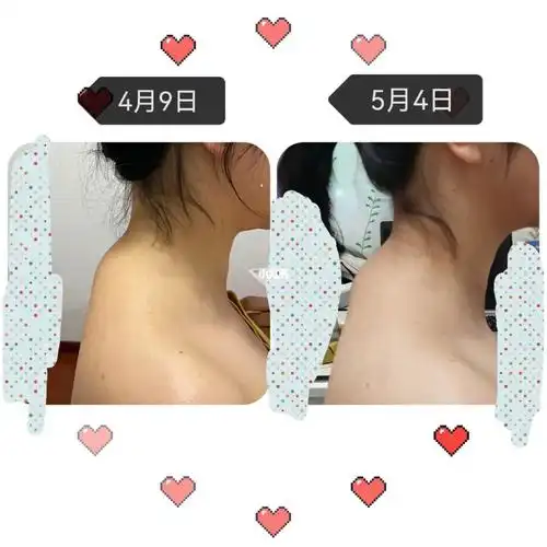 富贵包斜方肌肥厚这有改变么