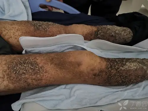 双侧腿皮肤病二十余年