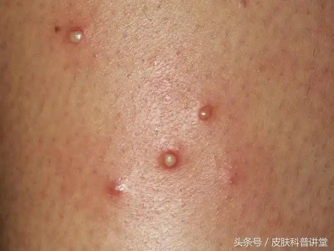 毛囊炎是什么症状图片 臀部毛囊炎的症状和图片-诚智百科网