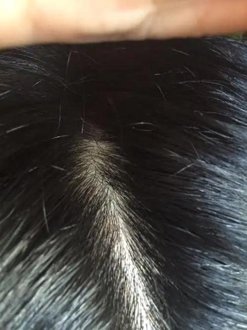 头发发根起小水泡是热症吗?是热症要怎么治疗?