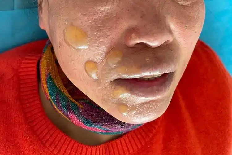 一度二度三度烫伤图片_有来医生