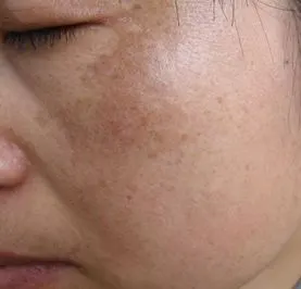 细说黄褐斑的症状都有哪些