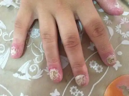 求真相,4岁宝宝的手为什么会烂成这样