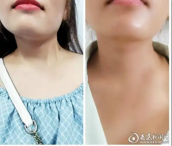 小手术助她告别32年的"歪脖子"生活——娄底市中心医院成功运用微创